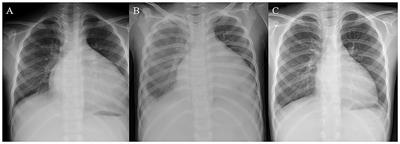 Case Report: Low Dose of Valsartan/Sacubitril Leads to Successful Reversal of Acute Heart Failure in Chemotherapy-Induced Cardiomyopathy